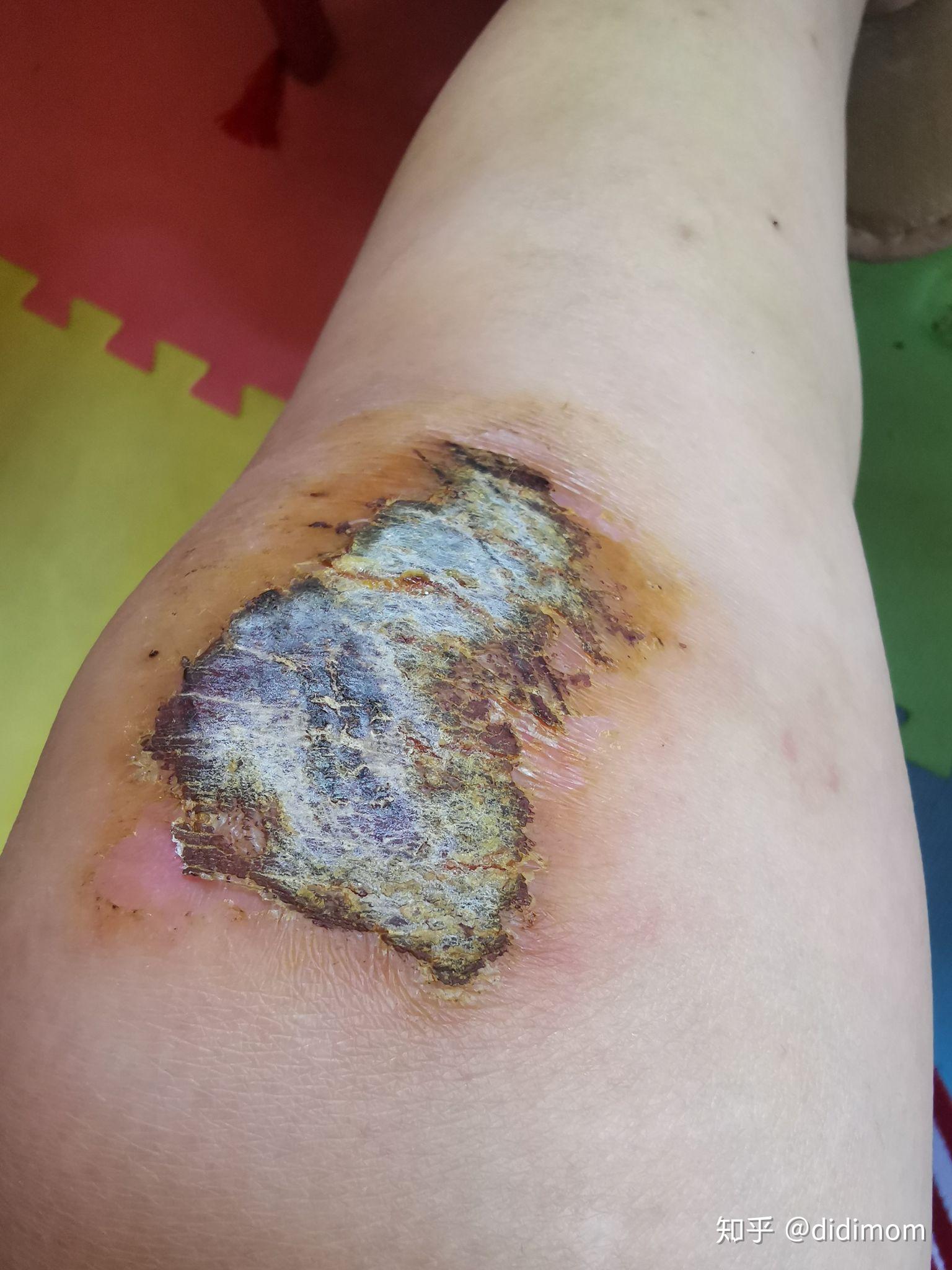 皮肤破后,流血结痂愈合是一个怎样的过程?