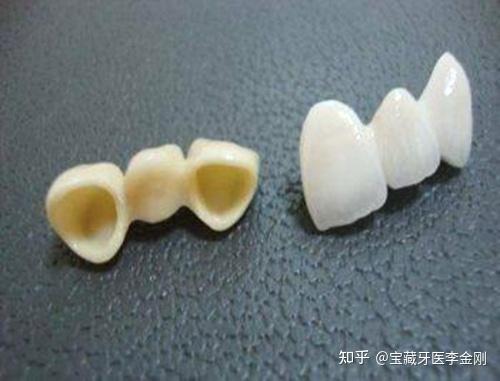 嵌体和牙冠哪个用的时间长,两者在牙齿修复方面有啥区别?