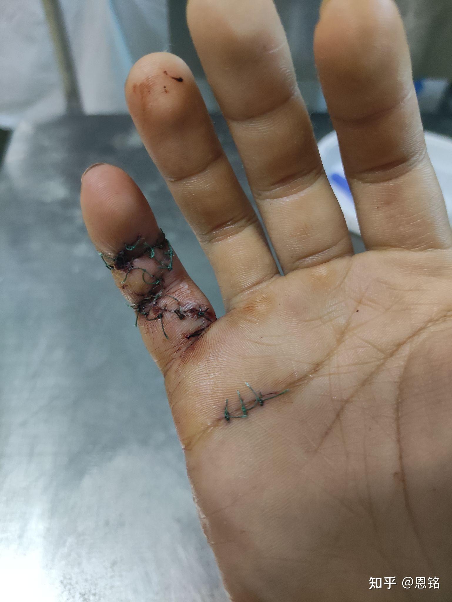 手指肌腱断裂最后一节无法伸直医生教我不要治疗了请问我该怎么做不