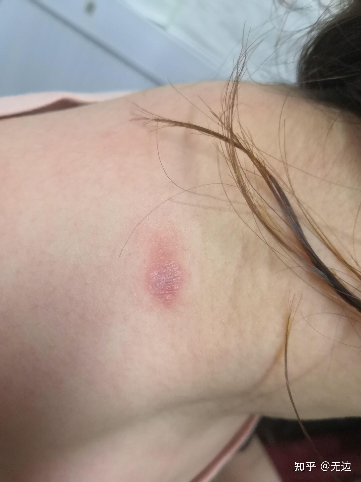 脖子后侧一块皮肤痒红的摸着粗糙是怎么回事