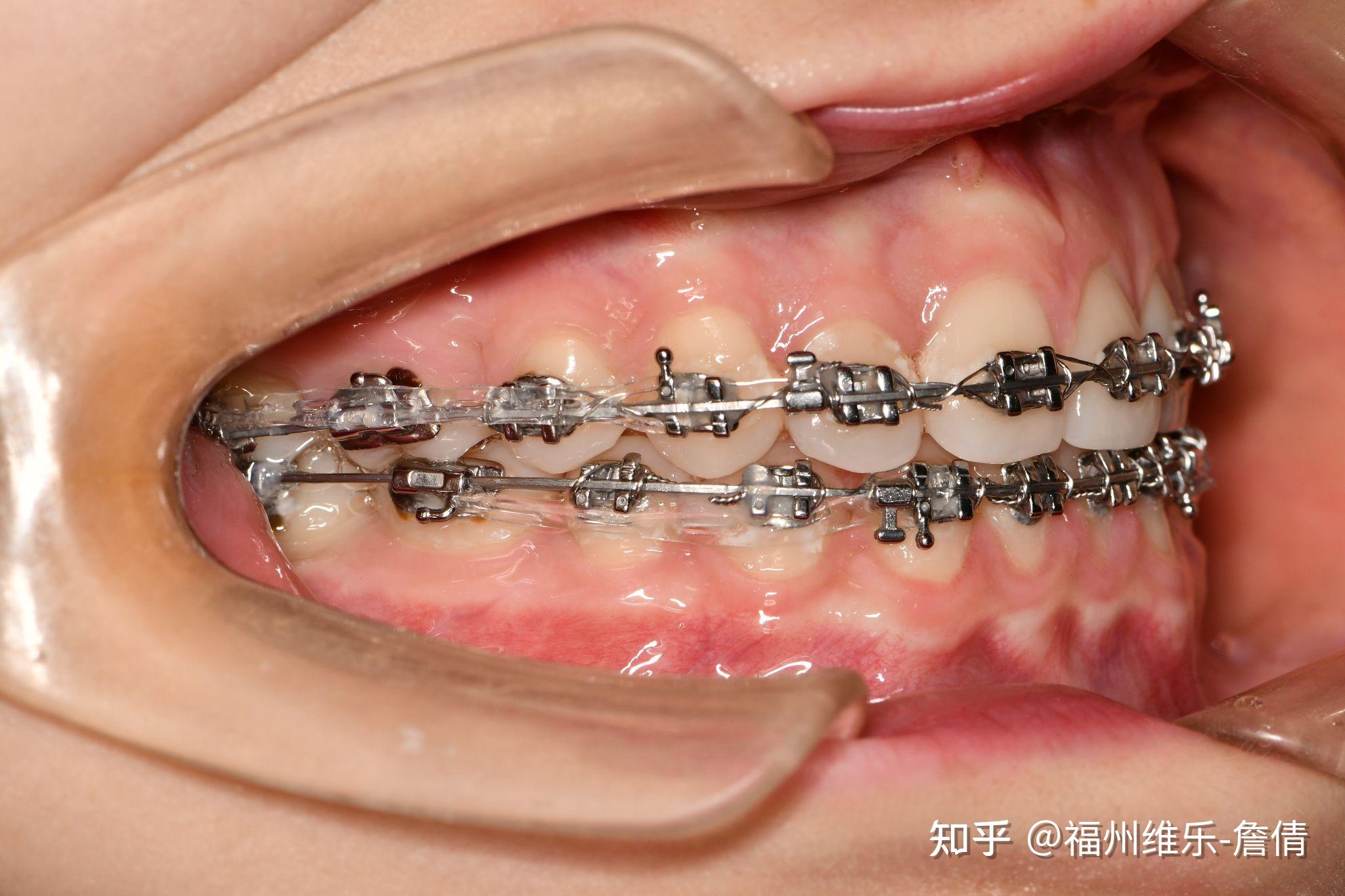 福州牙齿矫正后变美是种怎样的体验60