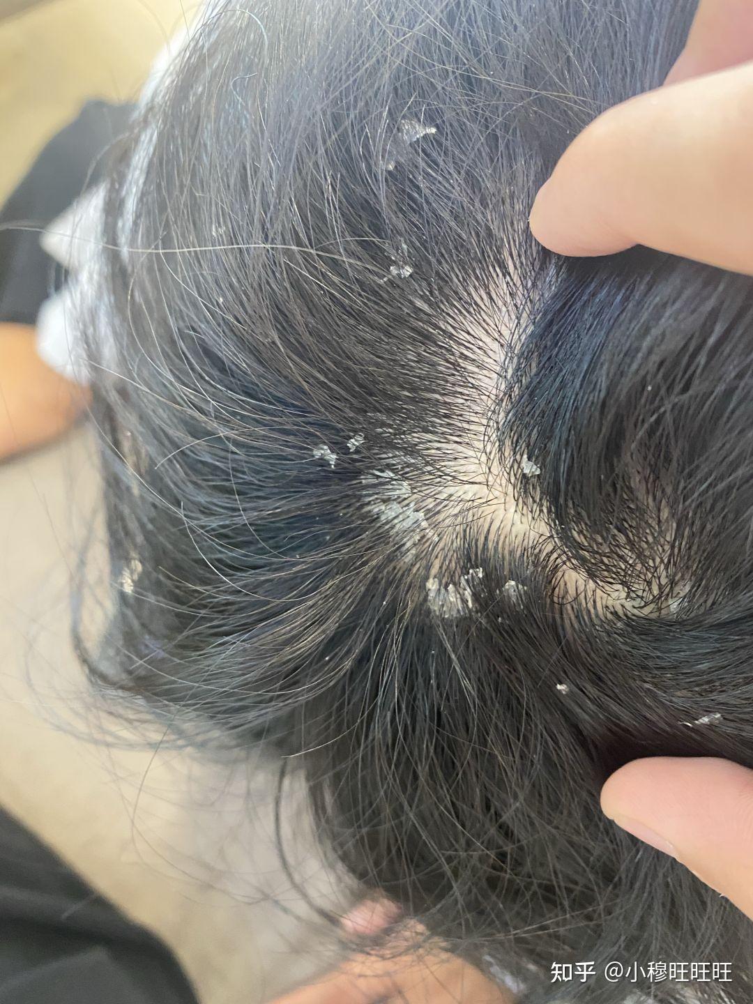 每天起床撸两下头发,头发就像仙女散花一样落下大片大片的头皮屑只要