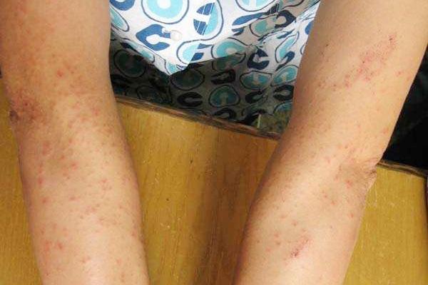 春风起皮肤痒血糖高是主因