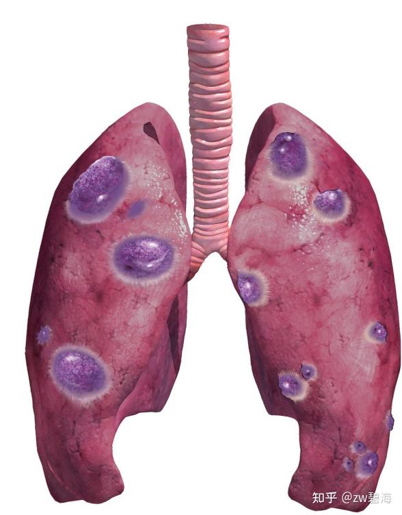 左肺上叶见磨玻璃结节影(se5  im113)大小约5×6mm.