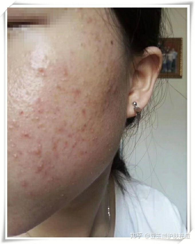 为什么纯牛奶容易爆痘