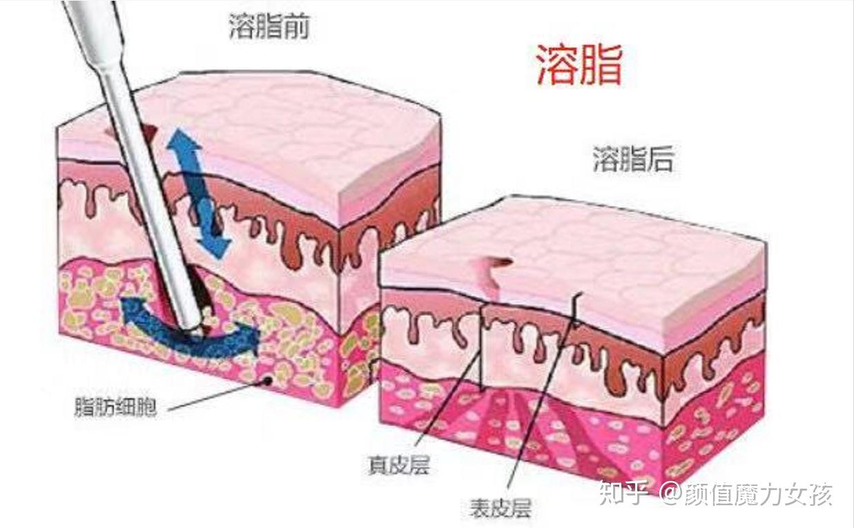 无针溶脂什么原理_无针雾化溶脂排点图(2)