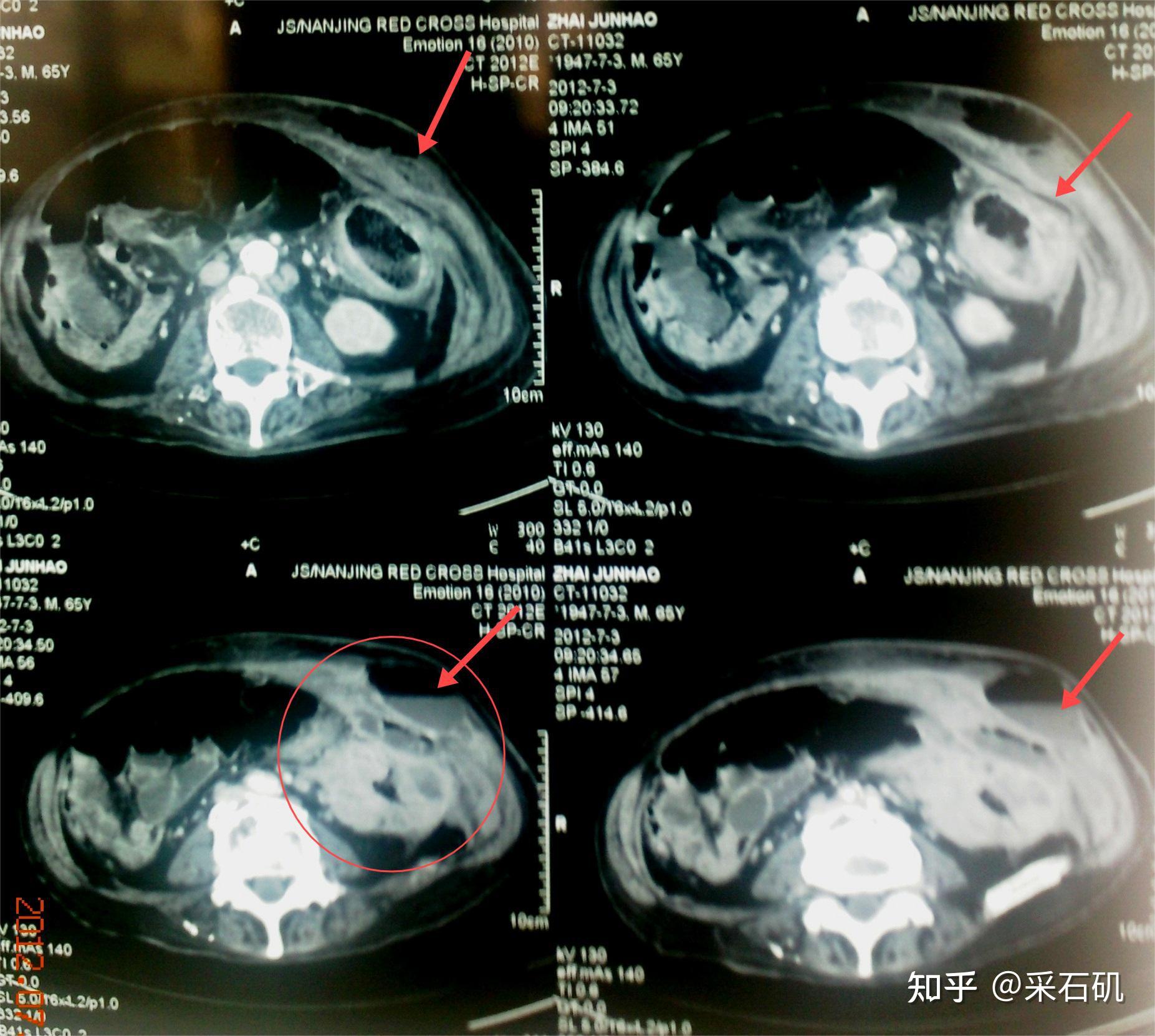 结肠癌影像图片图片