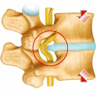 从腰椎间盘突出到坐骨神经痛 这个过程怎么度过与规避 知乎