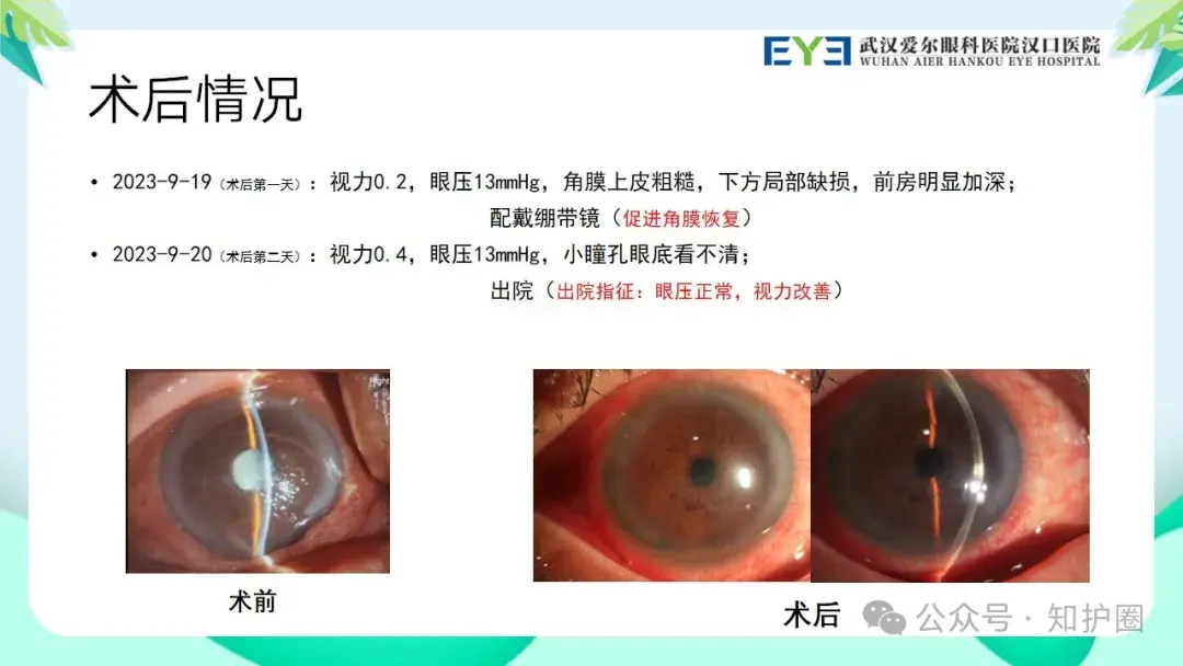 PPT】眼科疑难病例讨论：晶状体源性急性闭角型青光眼护理查房- 知乎