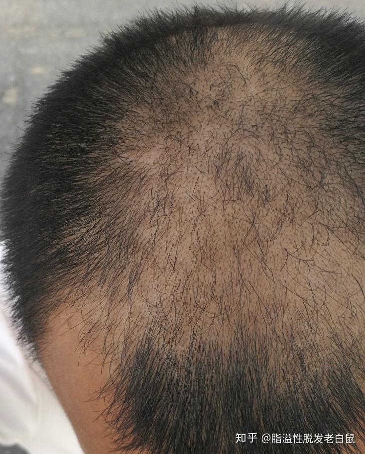 男性脂溢性脱发,恢复一年的效果展示