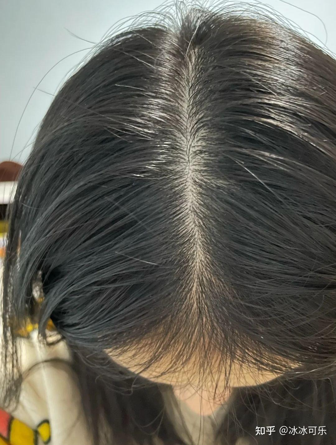 头顶上头发稀疏怎么办