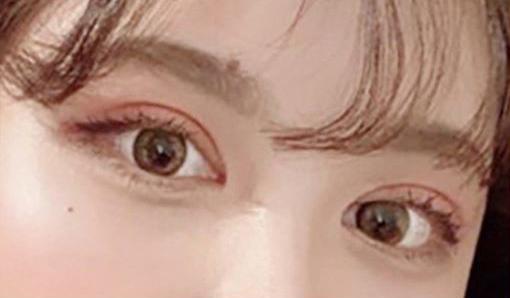 韩国小众医院超美女团眼眼整形案例分享 知乎