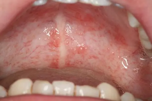 为什么冷酸灵牙膏用完口腔内脱皮? - 知乎