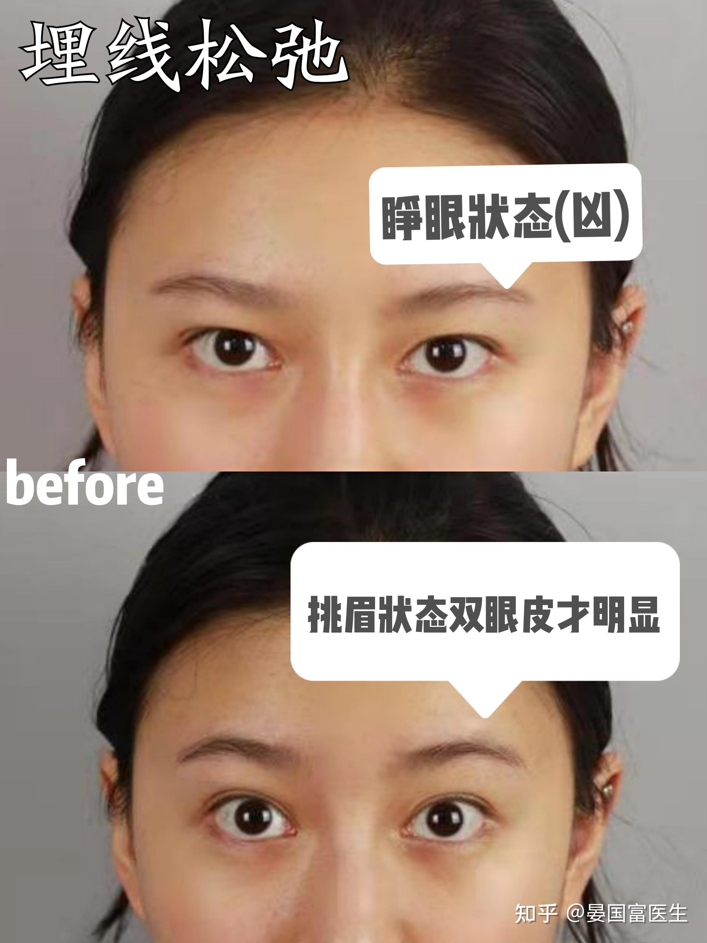 【双眼皮手术科普03】-埋线双眼皮多久能做双眼皮修复？埋线双眼皮和全切双眼皮适合哪些人？ - 知乎