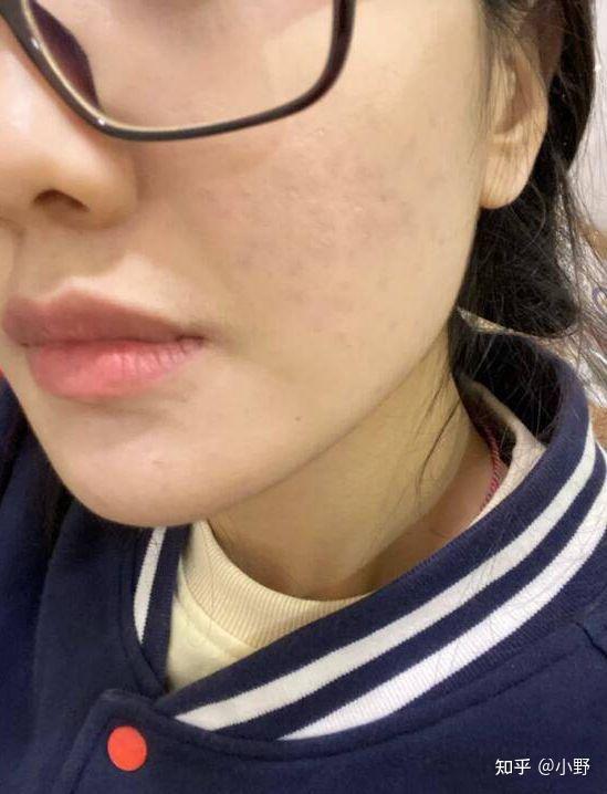 女23岁敏感肌大油皮痘痘严重一直都治不好痘痘都绝望了所以想寻求大神