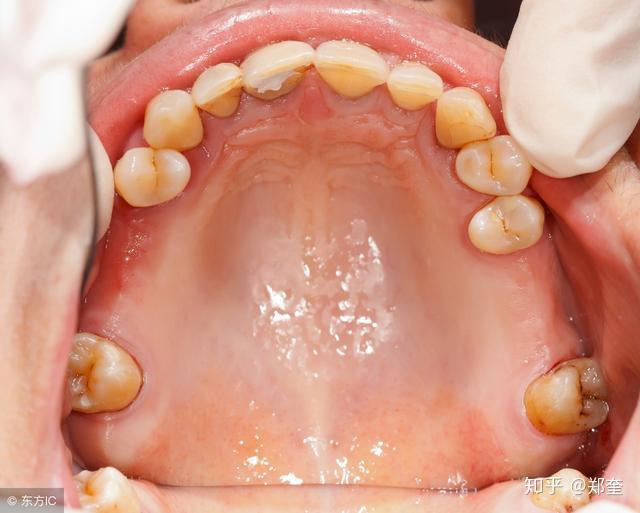 缺牙不去管小心牙齿全掉光