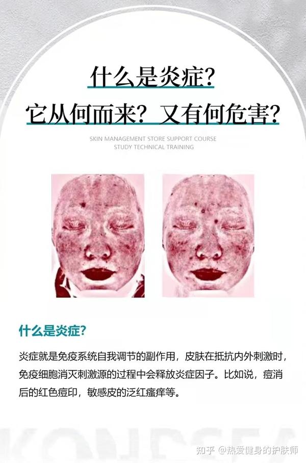 你对皮肤的炎症了解多少?