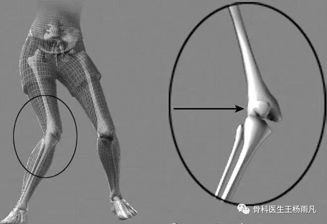 can i cycle with a torn meniscus