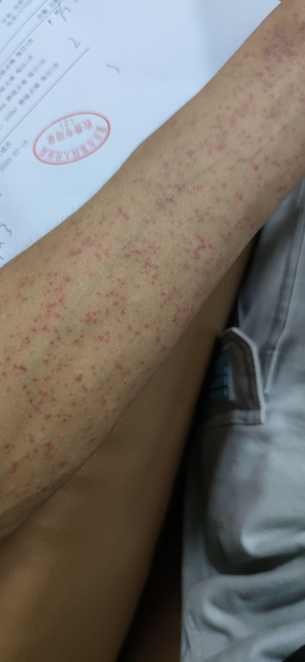 我身上起了好多红疙瘩起初是一些小红点特别痒还在增多这该怎么办大概