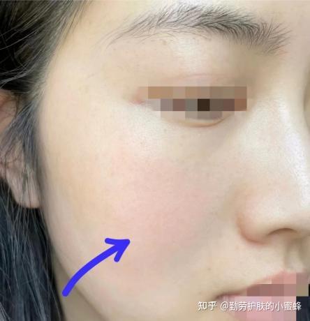 祛痘印成功!满脸痘印逆袭干净无暇的好皮肤!便宜去痘印产品,学生党不容错过!(附详细使用方法) - 知乎
