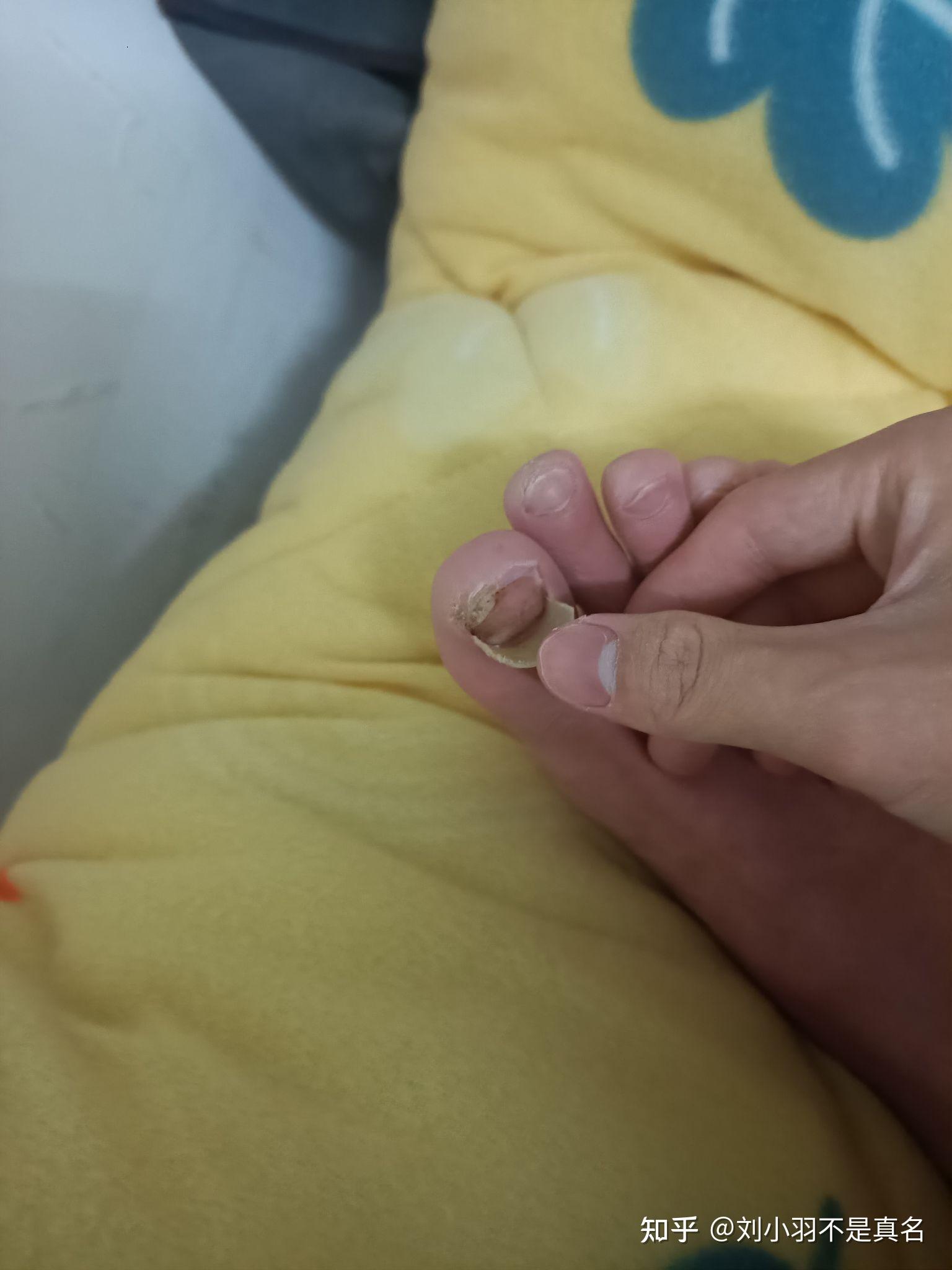脚趾甲要脱落了,下面那层已经长出来了,但是上面那层就是不掉,都一个