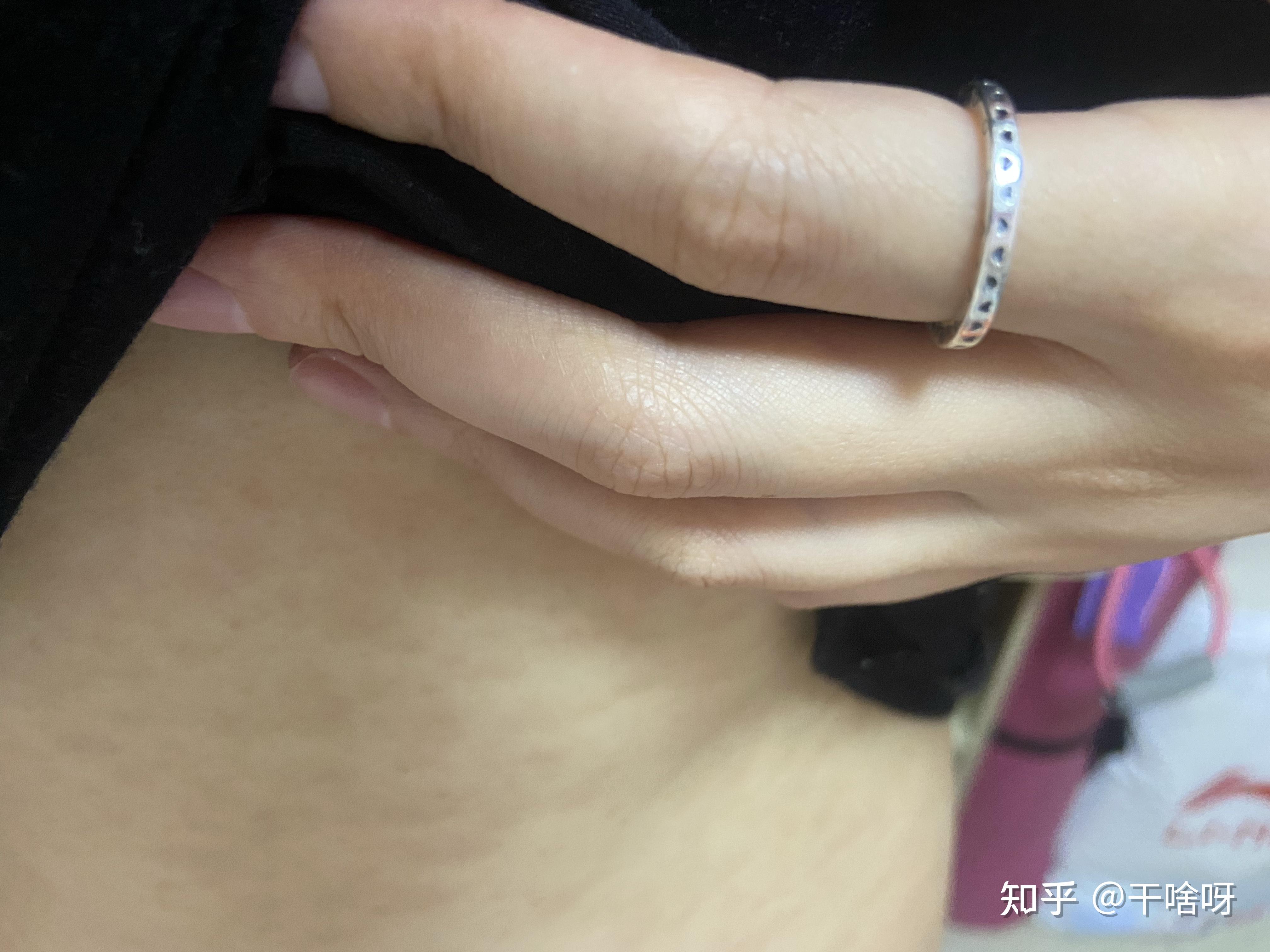 玫瑰糠疹不可怕