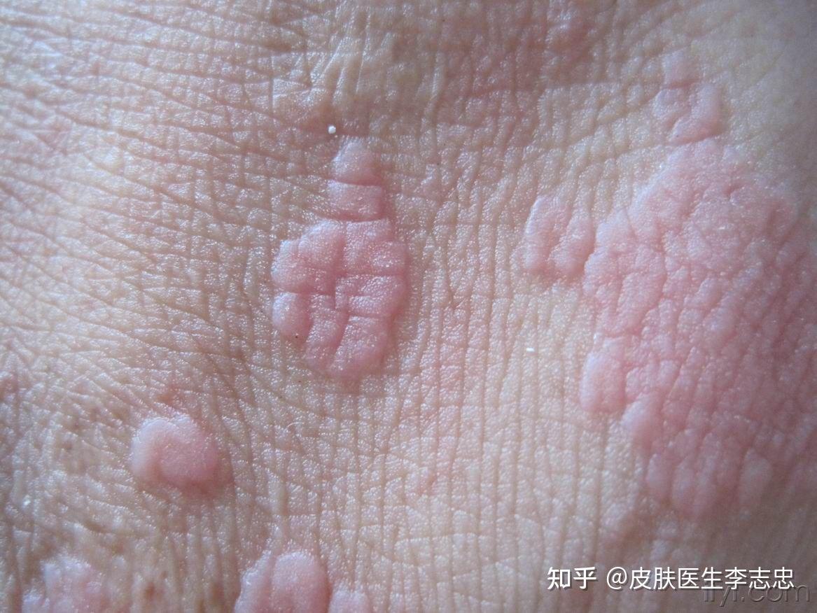 感染hpv皮肤图片