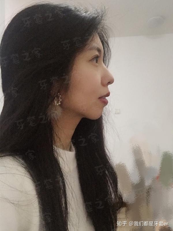 矫正10个月侧脸