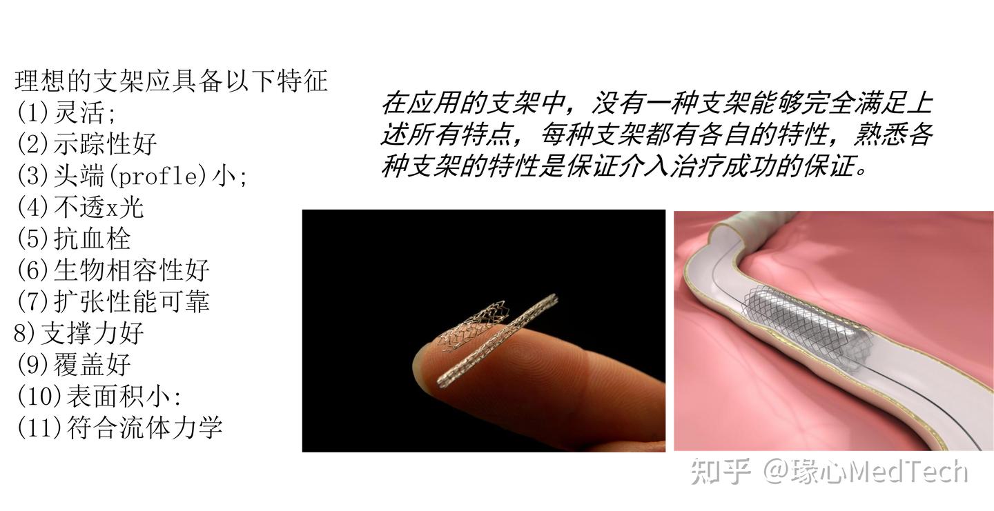 血管支架概况 - 知乎