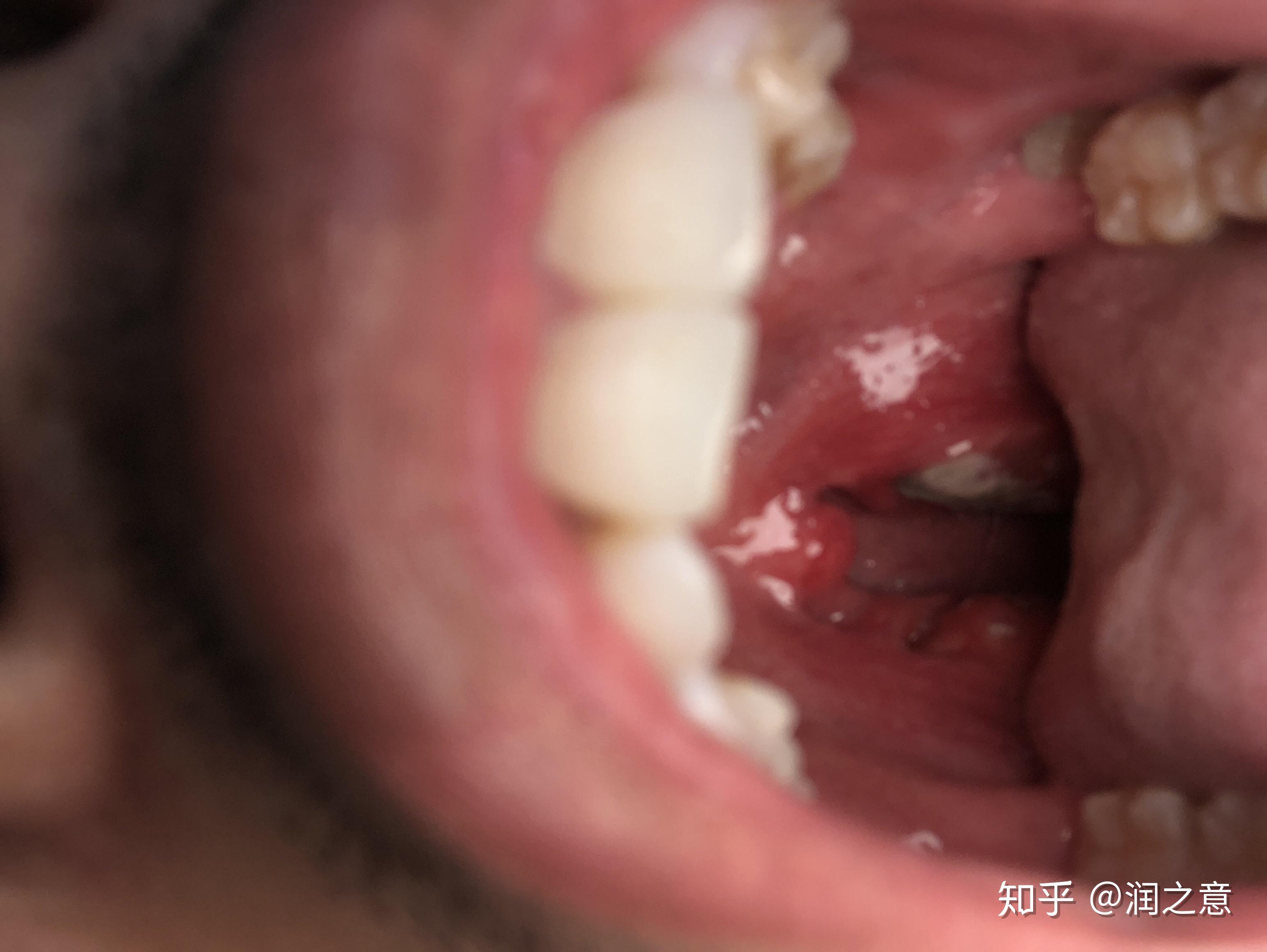 小孩喉咙白色化脓图片图片