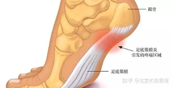 足踝科普系列(一)-足底筋膜炎