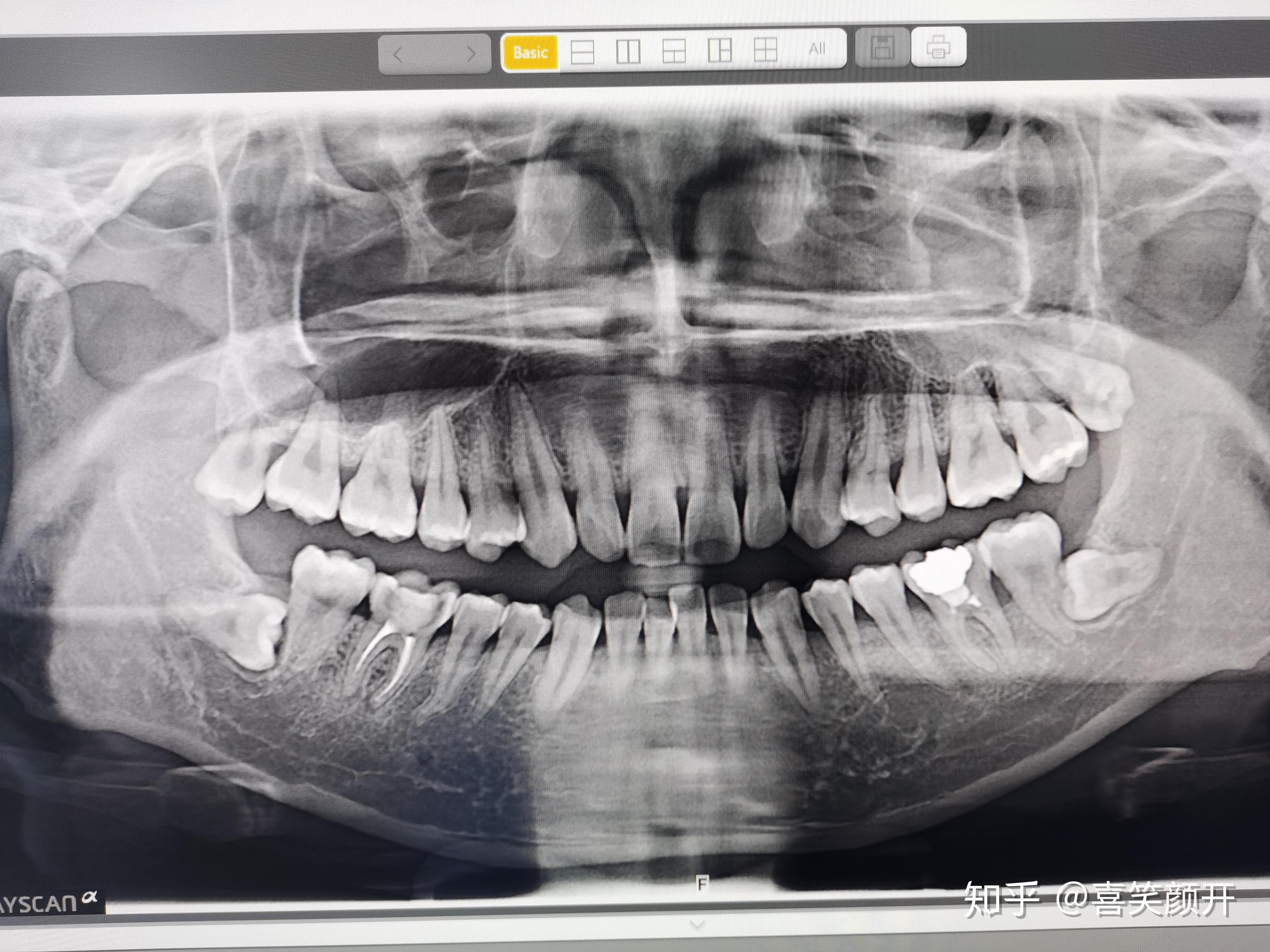 牙齿ct图片怎么看得懂图片