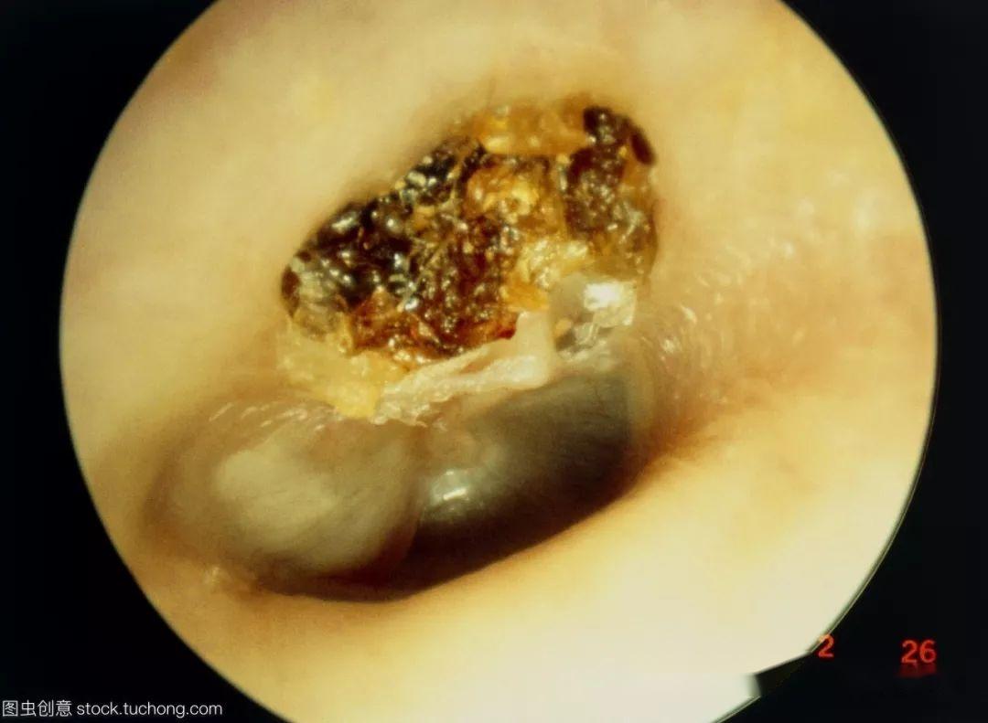外耳道胆脂瘤图片图片