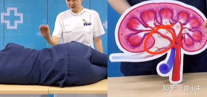 肾结石怎么排出? - 知乎