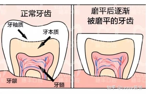 睡觉磨牙是怎么回事?磨牙久了还会损牙兼变丑? - 知乎