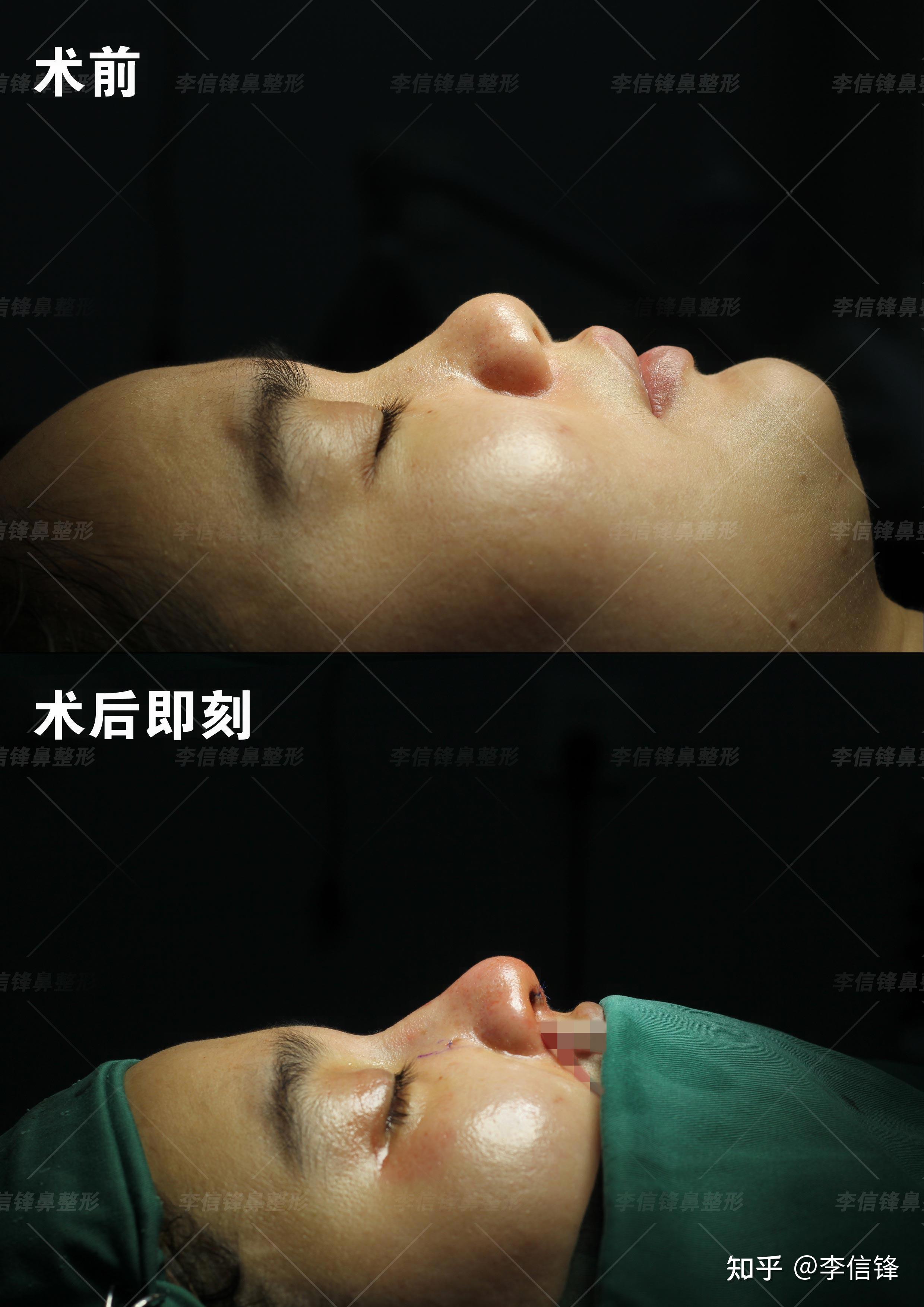 塌鼻子,大鼻头困扰?解决办法在这里。 - 知乎