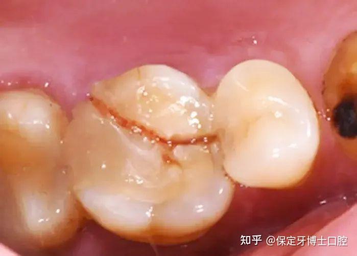 牙博士专家说 | 根管治疗后为什么要戴个牙冠? - 知乎