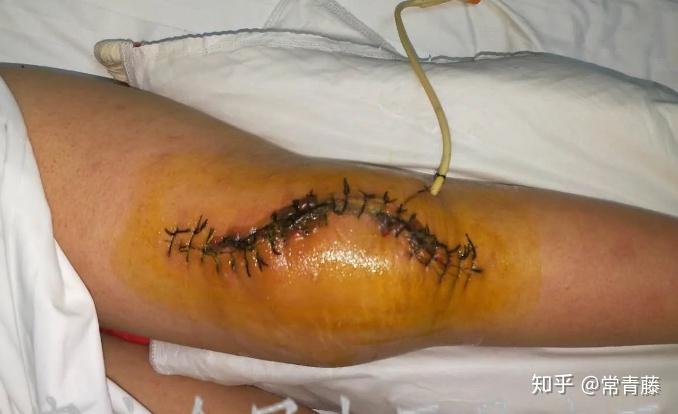 膝关节结核中医保守治疗过程