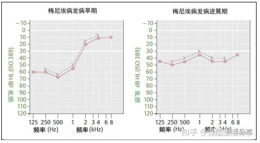 眩暈症和美尼爾氏綜合症的區別是什麼