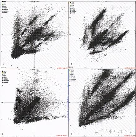 肌袖性房性心律失常的lorenz心电散点图特征研究