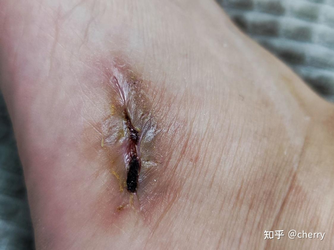 第五跖骨骨折