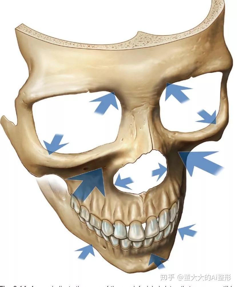 我们的骨骼随着衰老会发生骨吸收,眶骨和梨状孔会变大,立体度下降