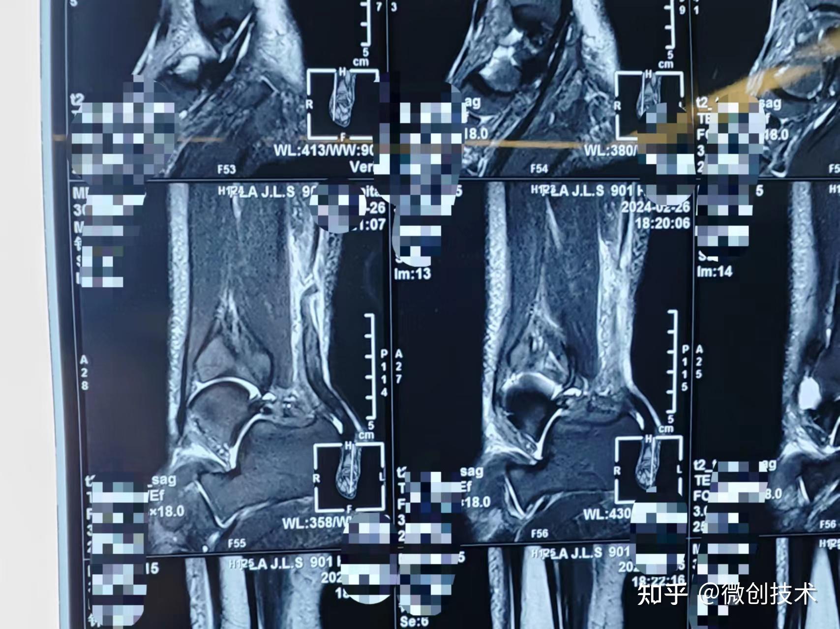 跟腱断裂mri图片