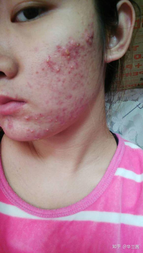 脓包型痘痘该怎么根除