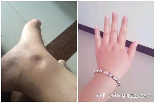 三个疗程的中药缓解水肿等甲减症状