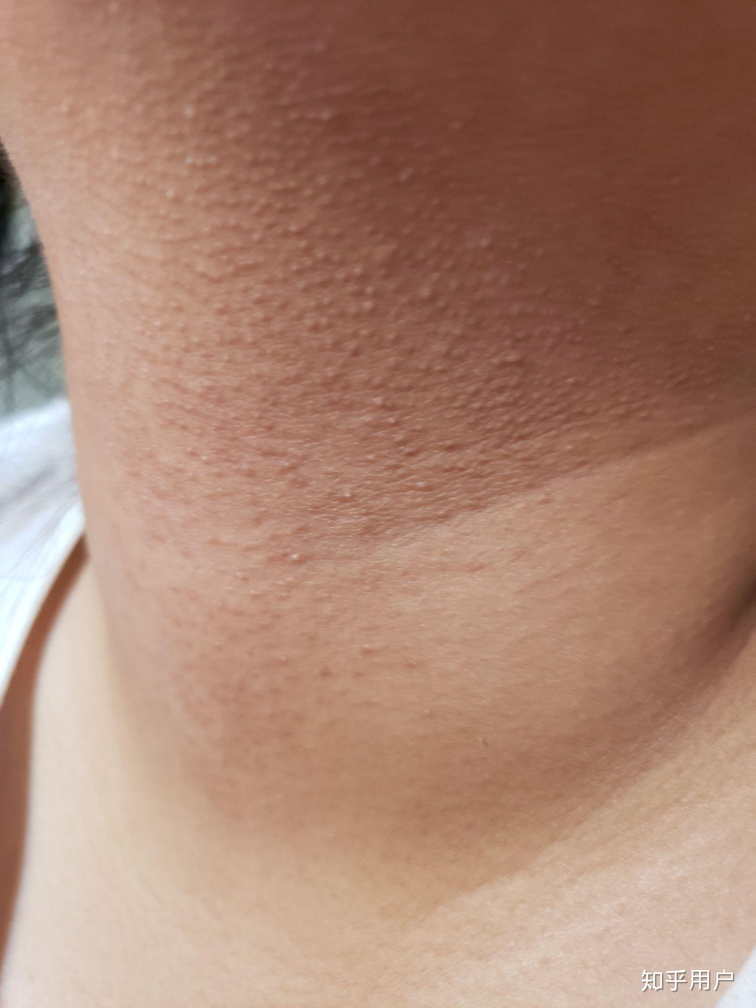 有严重的鸡皮肤是一种怎样的感受? - 知乎