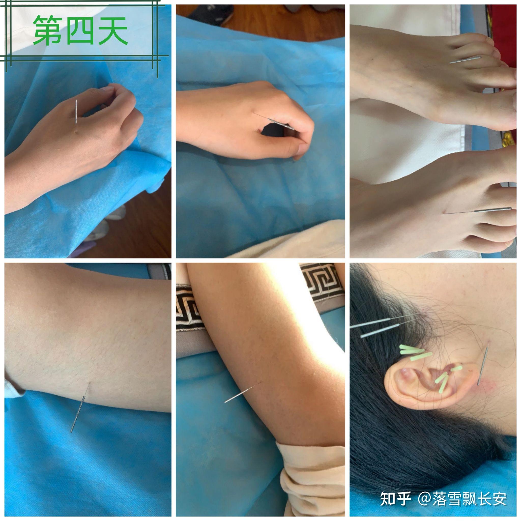 故事太长,感谢你有耐心今天第三次去针灸,为治疗颞下颌关节紊乱带来的