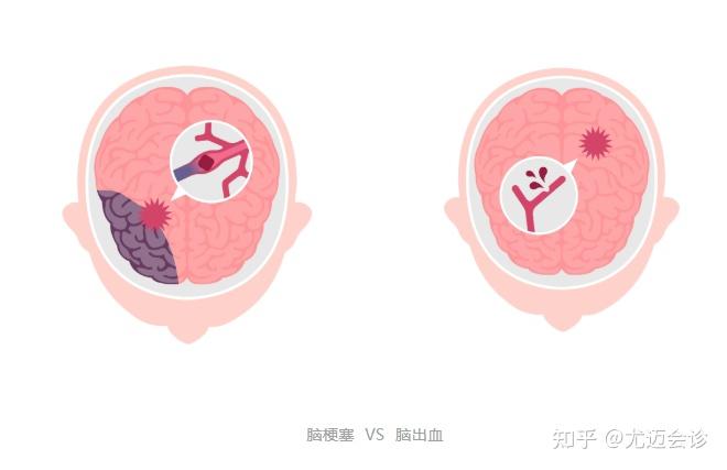 中风的4种前兆,记住一点能救命! - 知乎