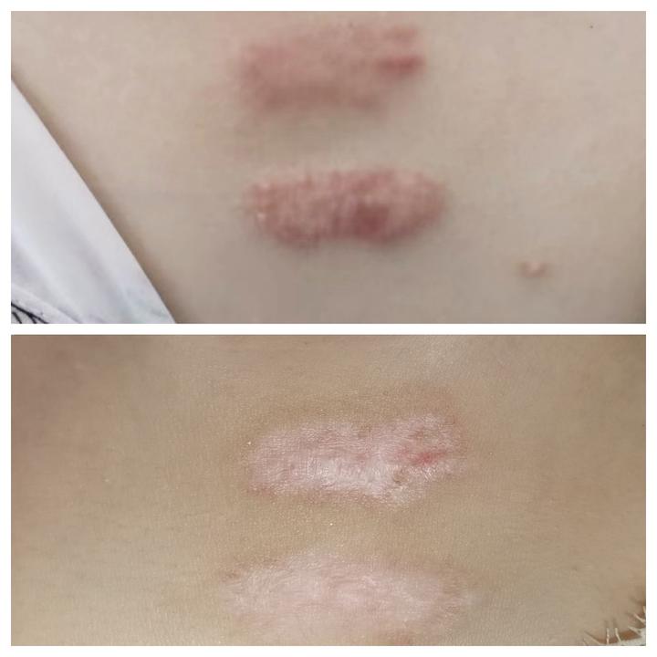 10多年的疤痕终于有救了 - 知乎