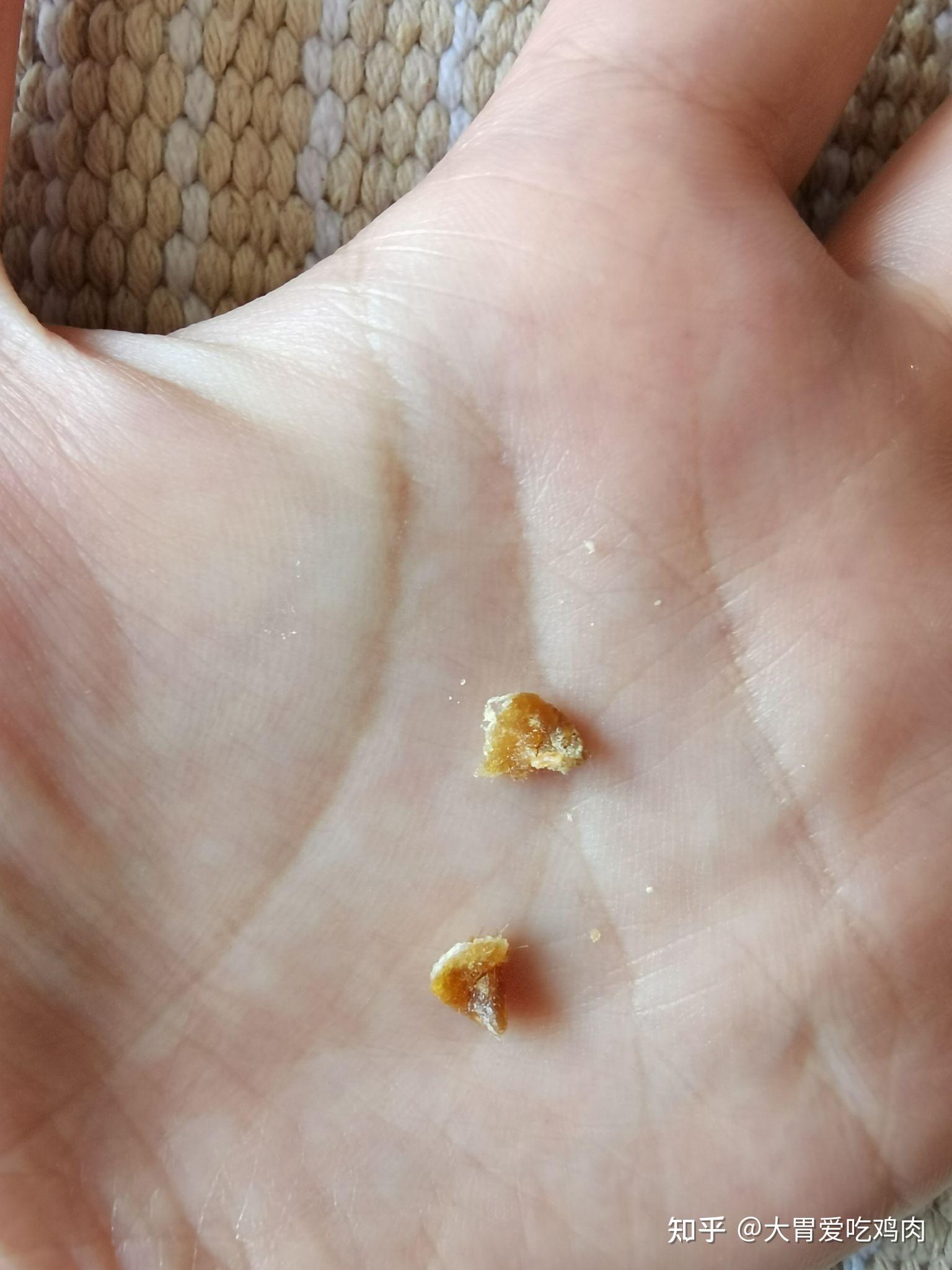 宝宝耳朵里的耳屎可以用挖耳勺取出来吗? - 知乎